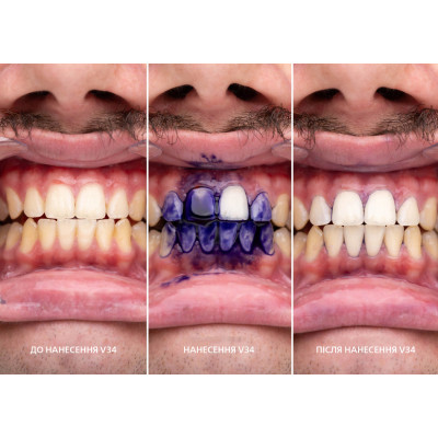 Средство для отбеливания зубов SmileKit V34 Корректор цвета зубов 30 мл (5.3010) Винница - изображение 3