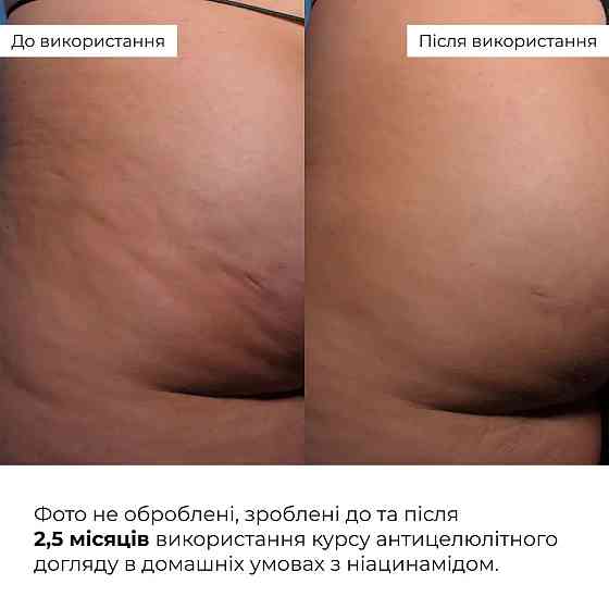 Курс антицеллюлитного ухода в домашних условиях с ниацинамидом Hillary Niacinamide Anti-Cellulite Home Care Киев