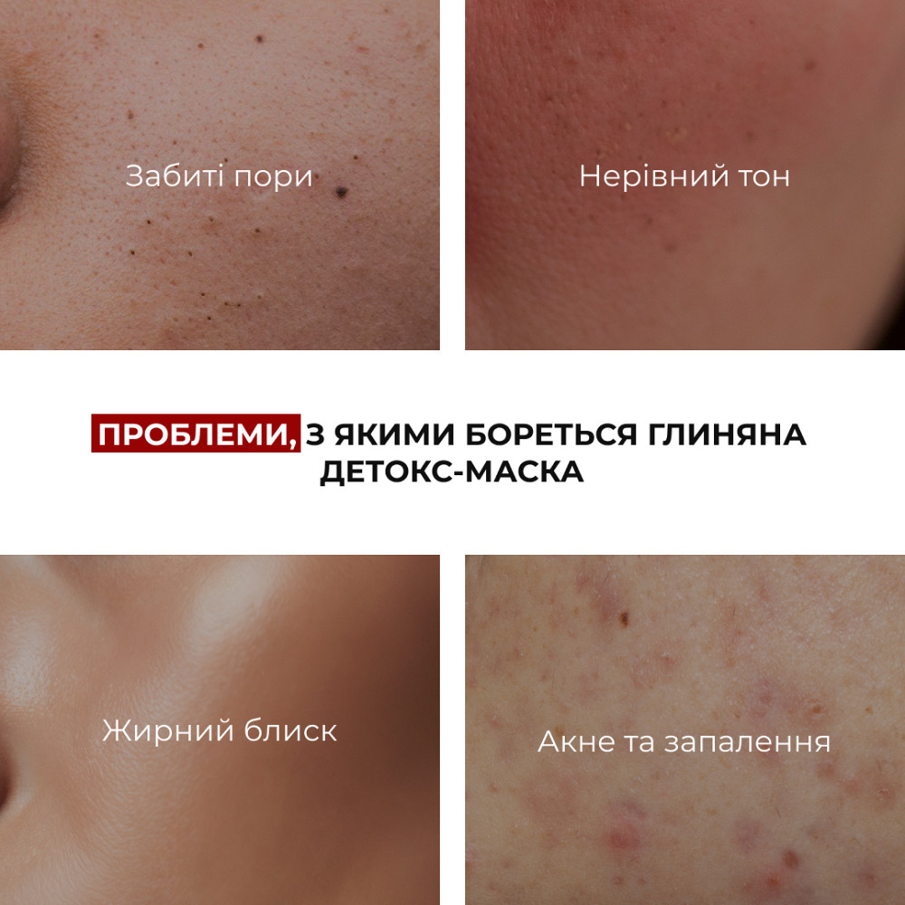 Глиняная детокс-маска для проблемной кожи лица Anti-Acne & Detox Clay Mask Hillary 90 мл Киев - изображение 7