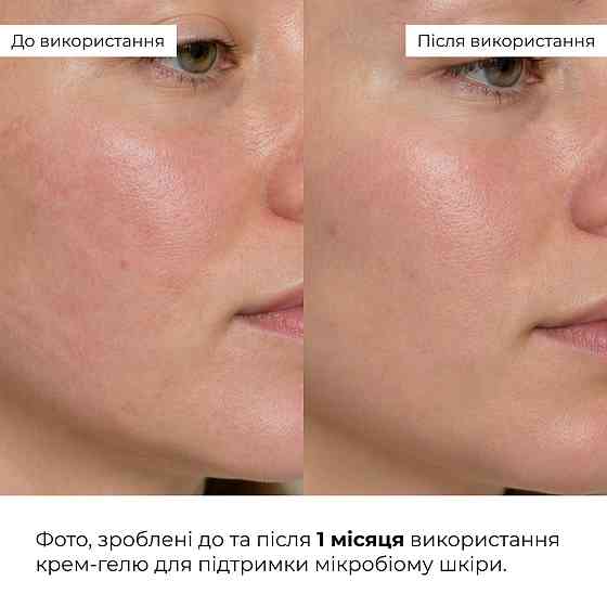 Набір для заспокоєння шкіри та підтримки захисного бар’єра Hillary Soothing & Skin Barrier Support Set Київ