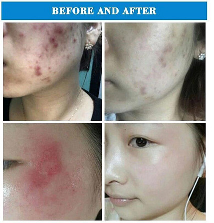 Портативний апарат дарсонвалізації Acne Meter WD-354 Вінниця - фото 7