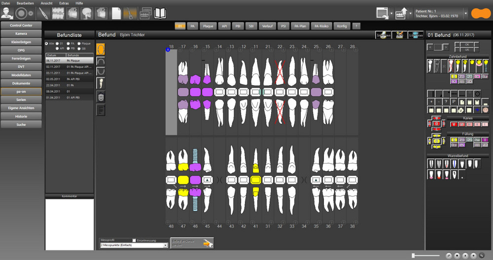 Пародонтальний зонд pa-on, OrangeDental Дніпро - фото 6