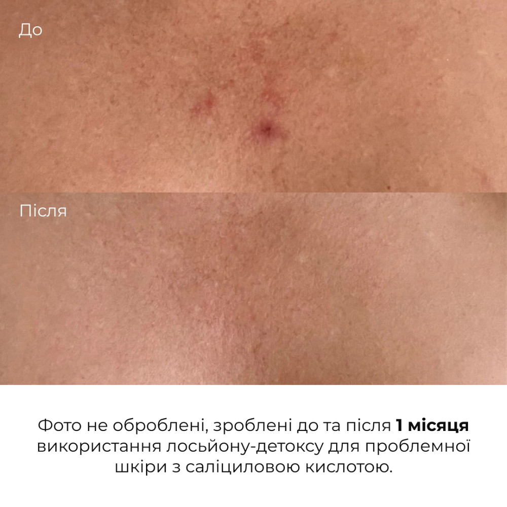 Лосьйон-детокс для проблемної шкіри з саліциловою кислотою Anti-Acne Salicylic Body Lotion Hillary 150 мл Київ - фото 9