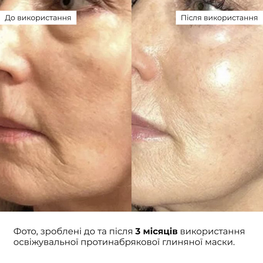 Комплекс для борьбы с отеками и тусклости кожи Hillary Anti-Puffiness & Dullness Skin Care Complex Киев - изображение 2