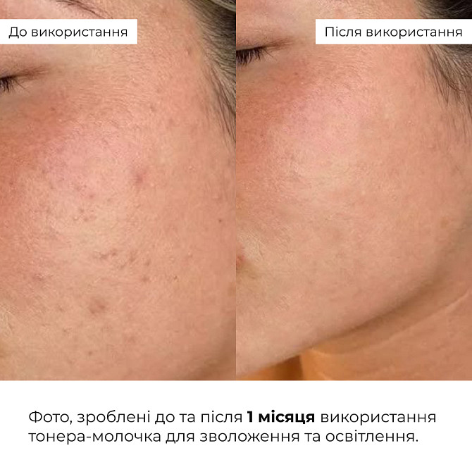 Комплексний б’юті-сет для жирної та комбінованої шкіри Perfect Niacinamide Sebo Balance Hillary Вінниця - фото 15
