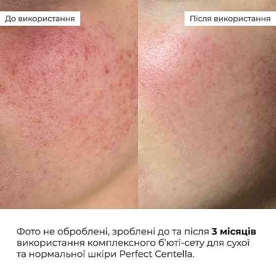 Комплексный бьюти-сет для сухой и нормальной кожи Perfect Centella Deep Hydration Hillary Киев