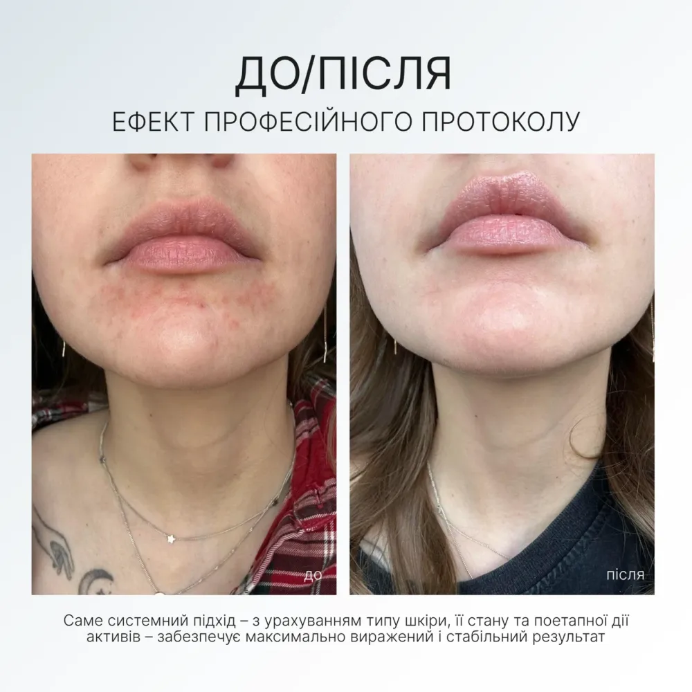 Балансуючий крем-гель при розацеа REDNESS BALANCE CREAM GEL AG Skin 50 мл Дніпро - фото 4