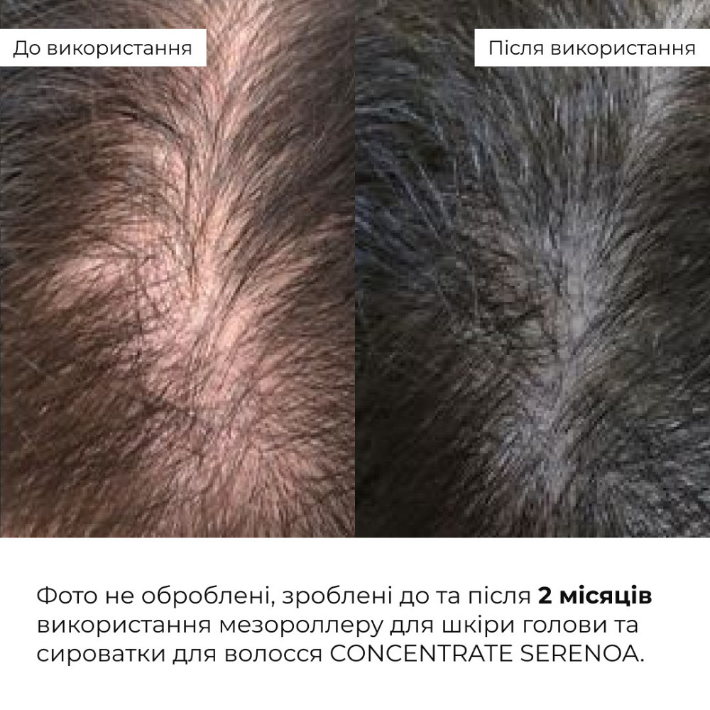 Мезороллер для шкіри голови Hillary + Сироватка для волосся CONСENTRATE SERENOA Київ - фото 2