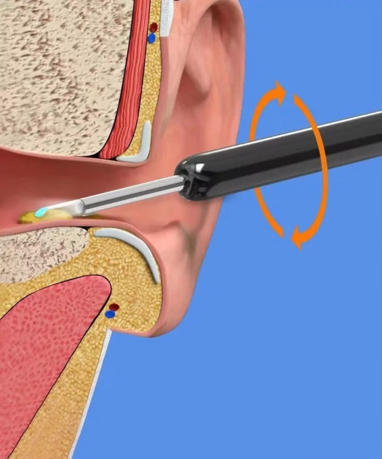 Беспроводной прибор для чистки ушей NE3 отоскоп Винница - изображение 10