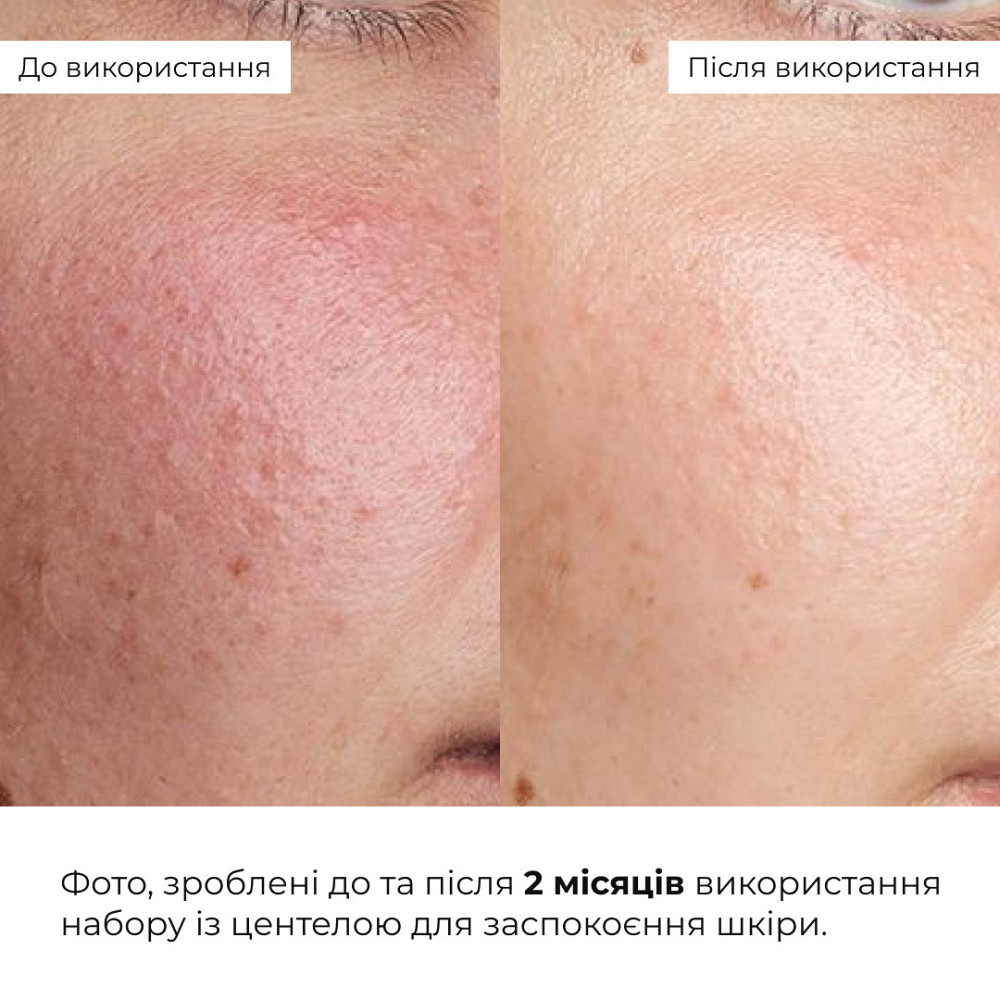 Набір із центеллою для заспокоєння та відновлення шкіри Hillary Centella Soothing & Recovery Set Київ - фото 2