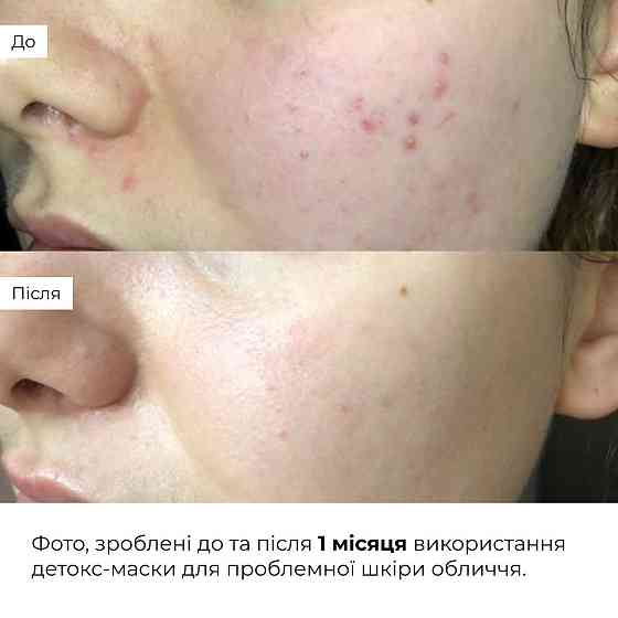 Набір для очищення та боротьби з акне Hillary Anti-Acne & Detox Skin Set Київ
