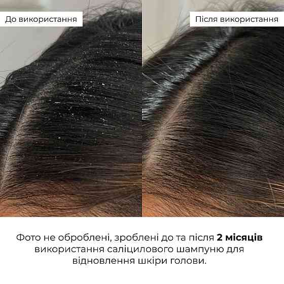 Саліциловий шампунь для відновлення шкіри голови Salicylic Scalp Reset Shampoo Hillary 400 мл Вінниця