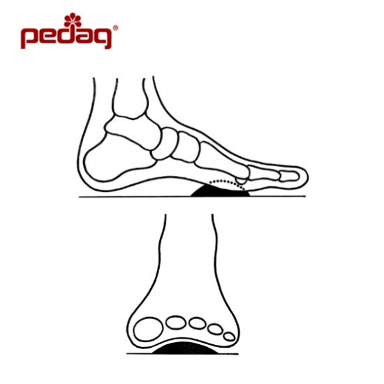 Ортопедична вставка під поперечне склепіння стопи T-form Дніпро - фото 3