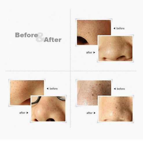 Інструмент для видалення вугрів та очищення пор Київ - фото 3