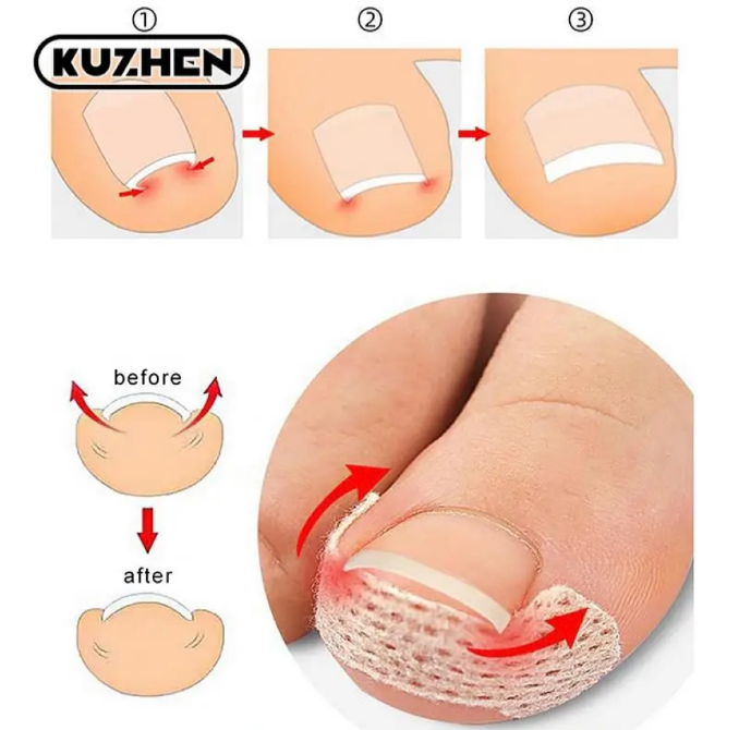 Пластырь для ногтей/ защита пальцев Кривой Рог - изображение 1