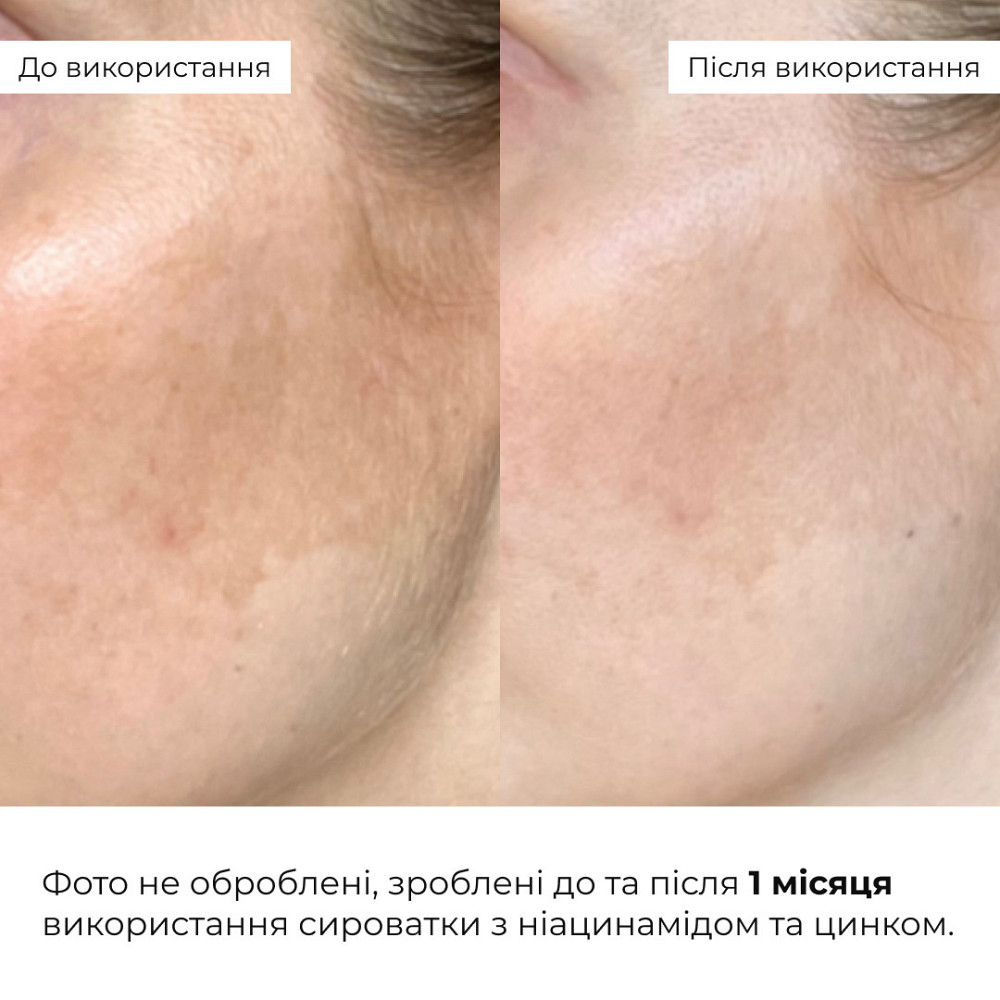 Мультироватка с ниацинамидом и цинком Hillary Multi Niacinamid serum, 30 мл Киев - изображение 8