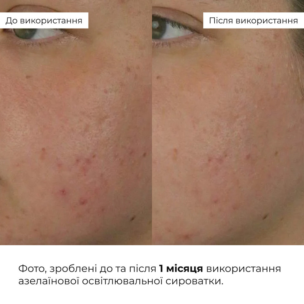 Набор для увлажнения и осветления тона кожи лица с азелаиновой кислотой Hillary Hydration & Azelaic Brightening Set Киев - изображение 12