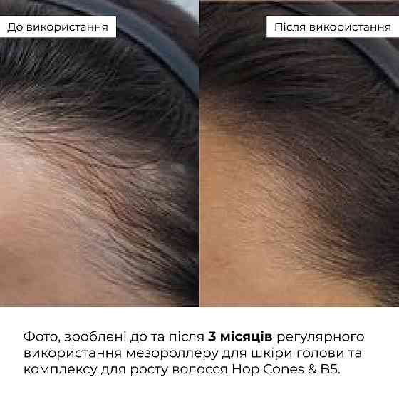 Мезороллер для шкіри голови + Комплекс для росту волосся Hop Cones & B5 Hair Growth Invigorating Київ
