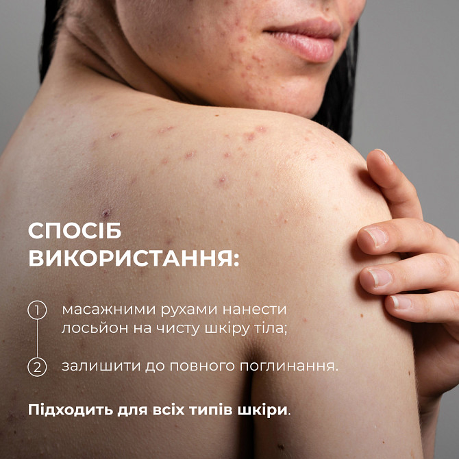 Лосьйон-детокс для проблемної шкіри з саліциловою кислотою Anti-Acne Salicylic Body Lotion Hillary 150 мл Вінниця - фото 7