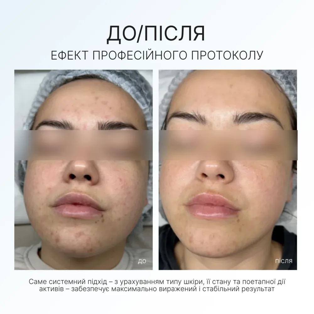 Набор для профилактики и лечения акне Acne Set AG Skin Днепр - изображение 4