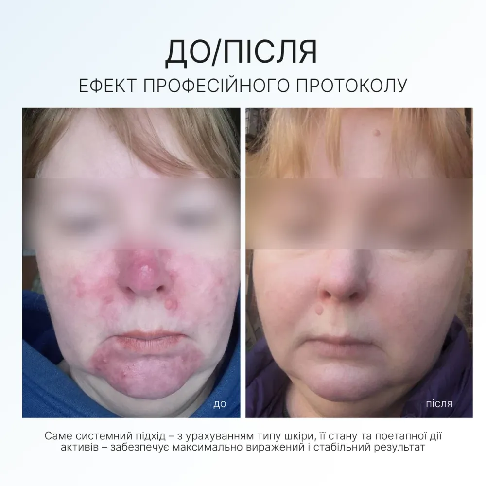 Набір для профілактики та лікування розацеа Rosacea Set AG Skin Дніпро - фото 2