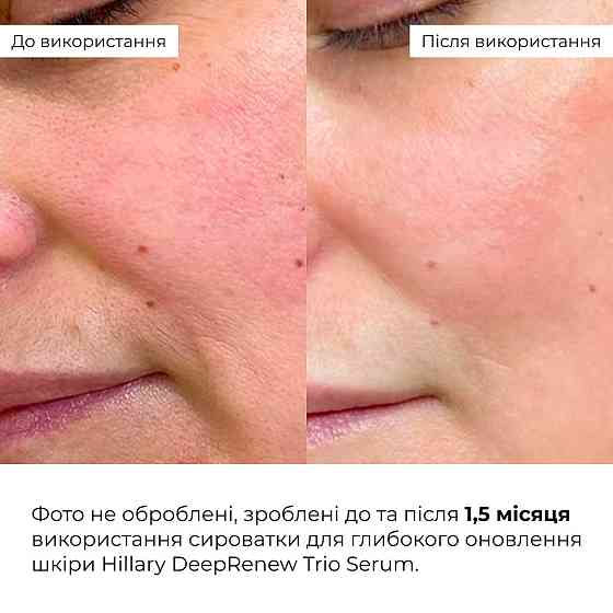 Набір для оновлення та заспокоєння шкіри Hillary Skin Renewal & Calming Kit Київ