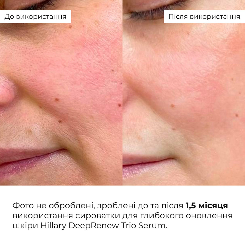 Набір для оновлення та заспокоєння шкіри Hillary Skin Renewal & Calming Kit Київ - фото 2